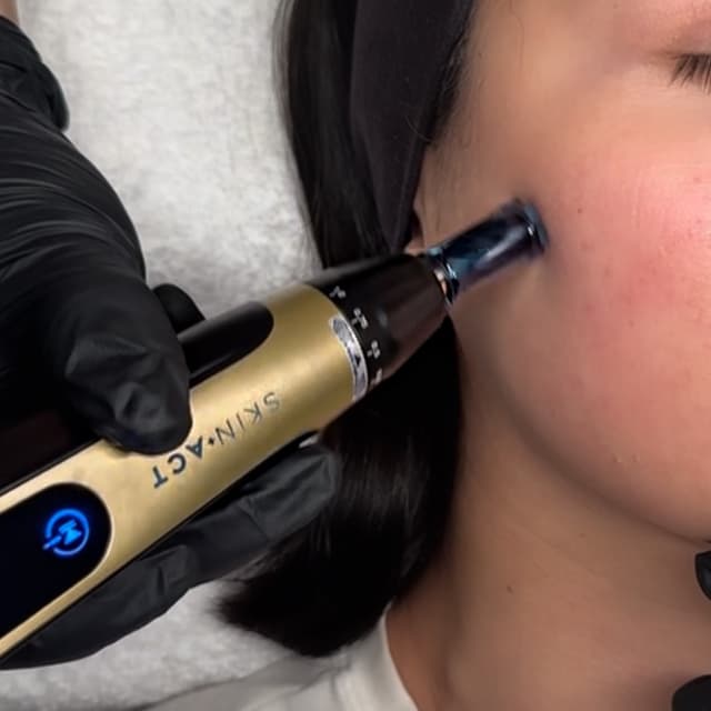 6 Nanoneedling Treatments at Rain Aesthetics in Rancho Cucamonga, CA