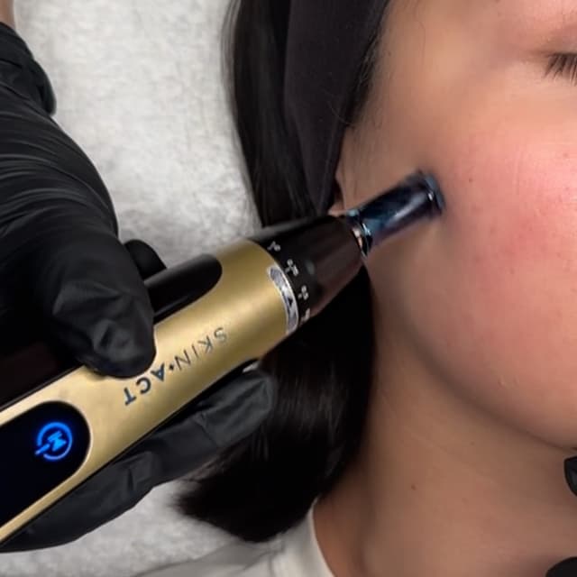 3 Nanoneedling Treatments at Rain Aesthetics in Rancho Cucamonga, CA